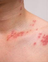 Efektivní zmírnění psoriázy a ekzémů
